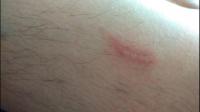 大腿也不知被什么虫子咬了